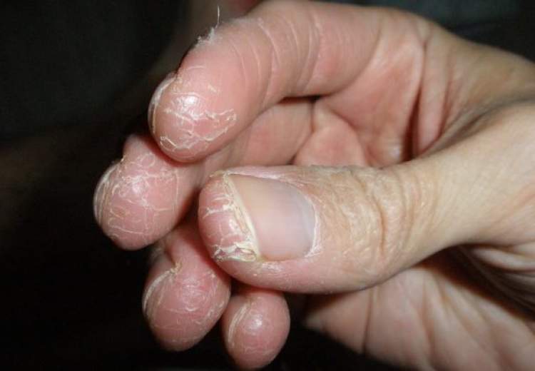 راه‌های پیشگیری از اگزما در ایام کرونا