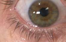 کدام تغییرات در چشم نشانه ابتلا به کروناست؟