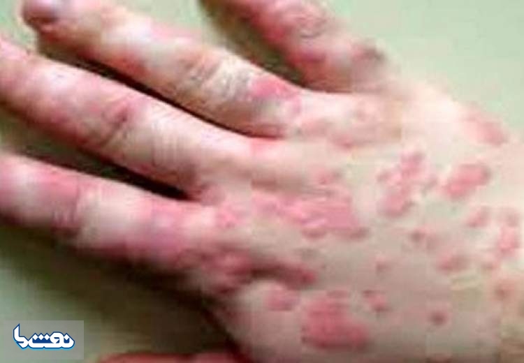 مهمترین علائم «پوستی» ابتلا به کرونا